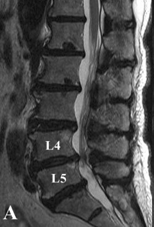 Imaging of Spinal Stenosis - Illinois Chiropractic Society