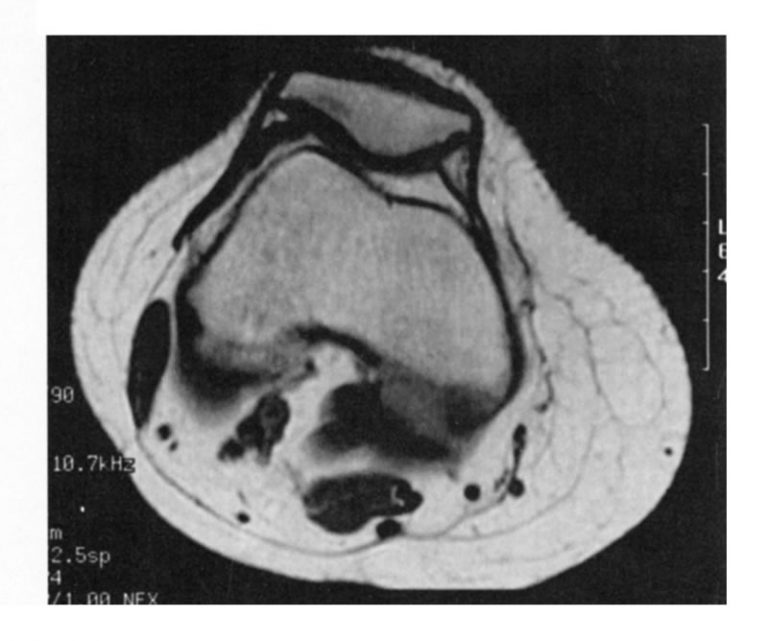 The Imaging of Chondromalacia Patella Illinois Chiropractic Society