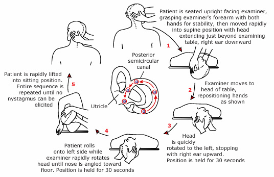 Diagram of Eply's maneuver