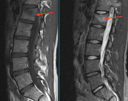 Vertebral Body Compression Fracture, New vs Old - Illinois Chiropractic ...