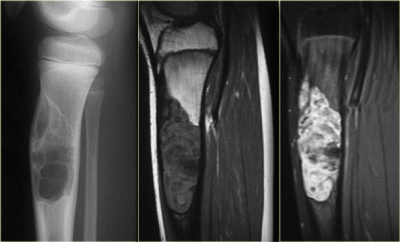 Фиброма кости. Фиброзная дисплазия (болезнь Брайцева-Лихтенштейна). Фиброзно-кистозная дисплазия большеберцовой кости. Полиоссальная фиброзная дисплазия. Фиброзная дисплазия бедренной кости мрт.