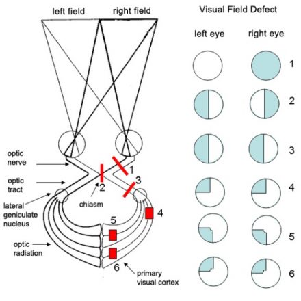 Visual Pathway Lesions - Illinois Chiropractic Society