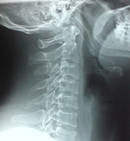 Calcification Of The Stylohyoid Ligaments And Thyroid Cartilage
