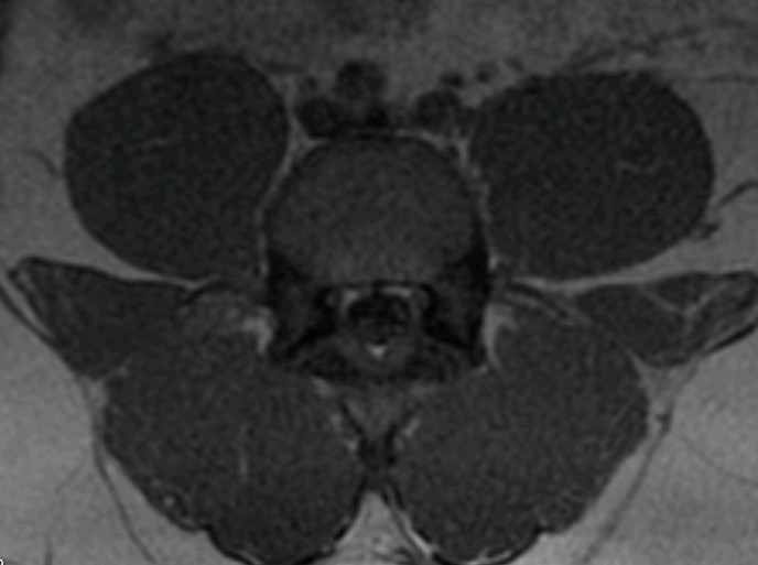 mri-detection-of-paraspinal-muscle-atrophy-in-lower-back-pain