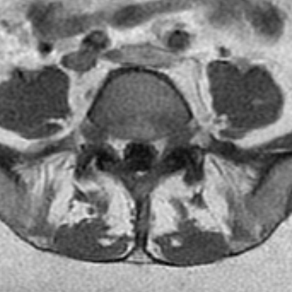 MRI Detection of Paraspinal Muscle Atrophy in Lower Back Pain ...