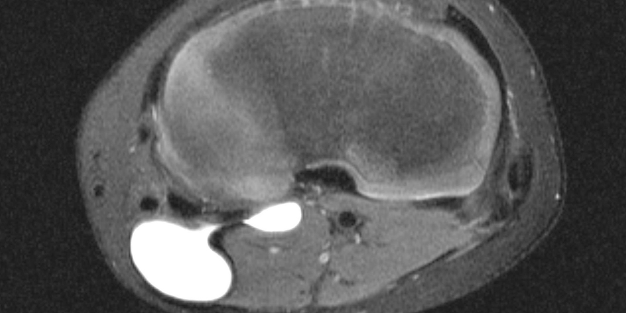 The MRI Appearance and Significance of the Popliteal Cyst