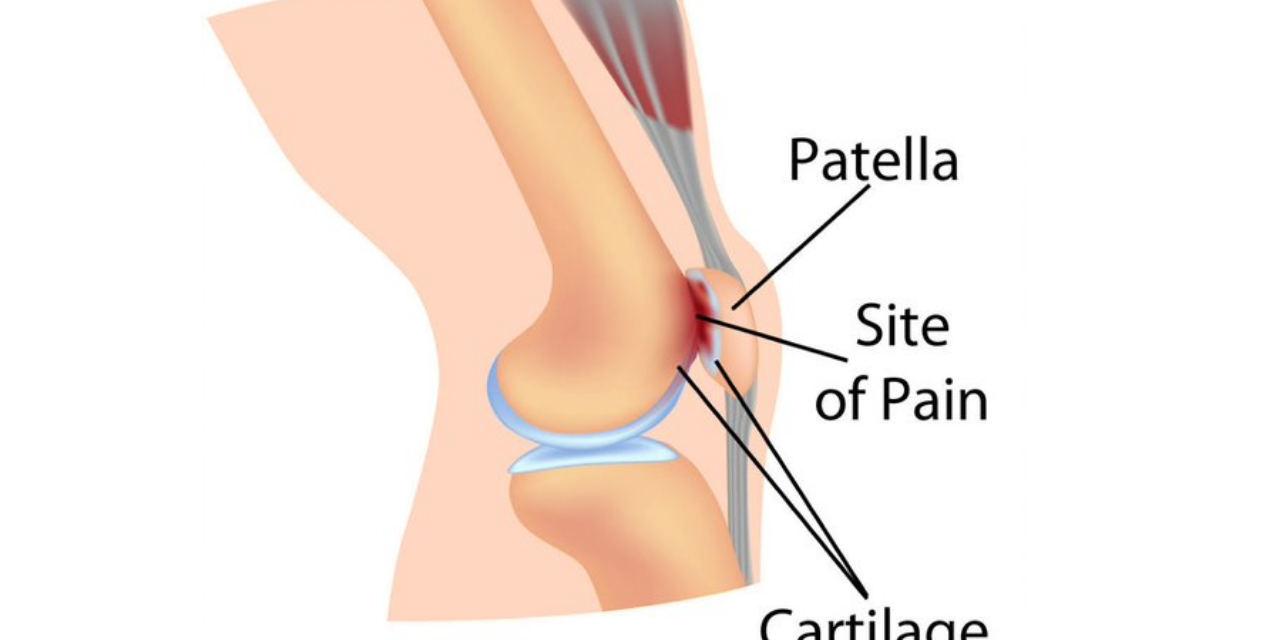 Patellofemoral Pain Syndrome