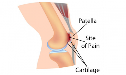 Patellofemoral Pain Syndrome