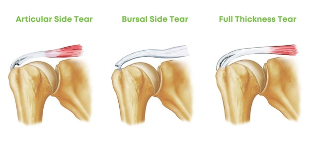 Is It a Full-Thickness or a Partial-Thickness Tear of the Rotator Cuff ...