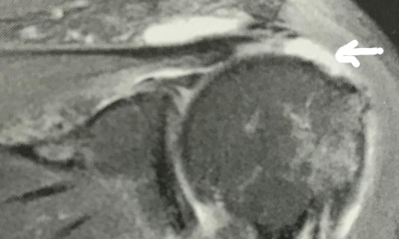 MRI Appearance of Adhesive Capsulitis