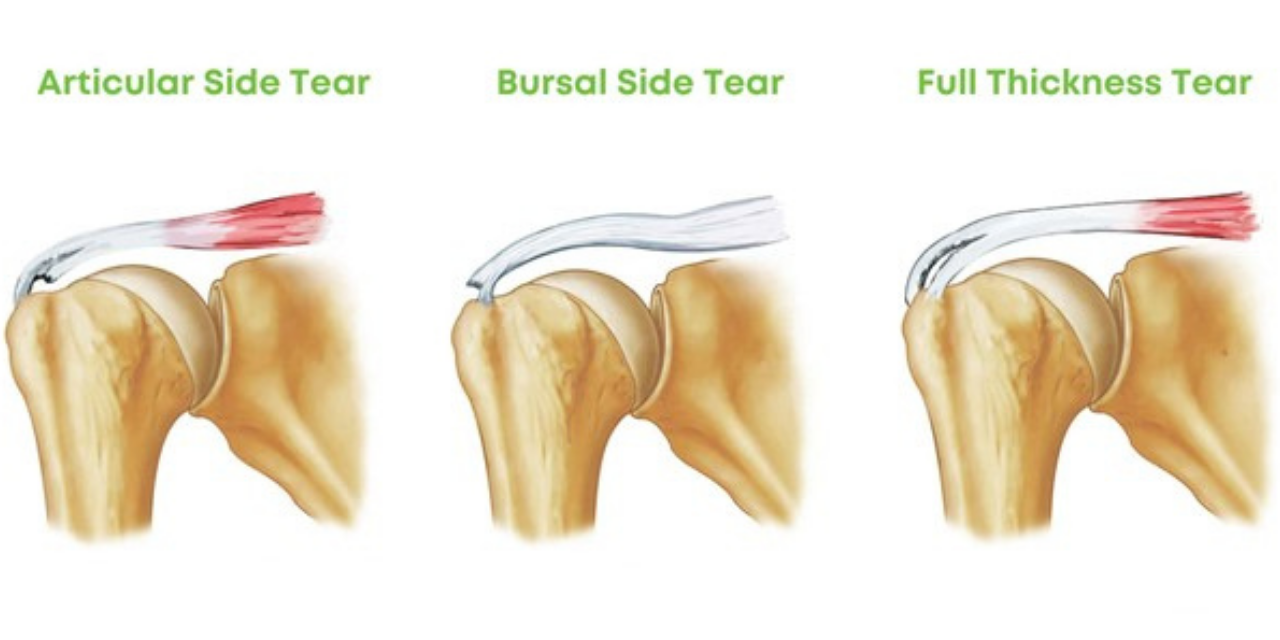 Is It a Full-Thickness or a Partial-Thickness Tear of the Rotator Cuff?