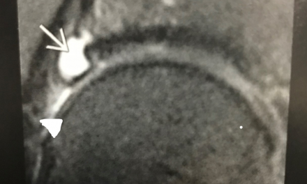 MRI Appearance of Acetabular Labral Tears
