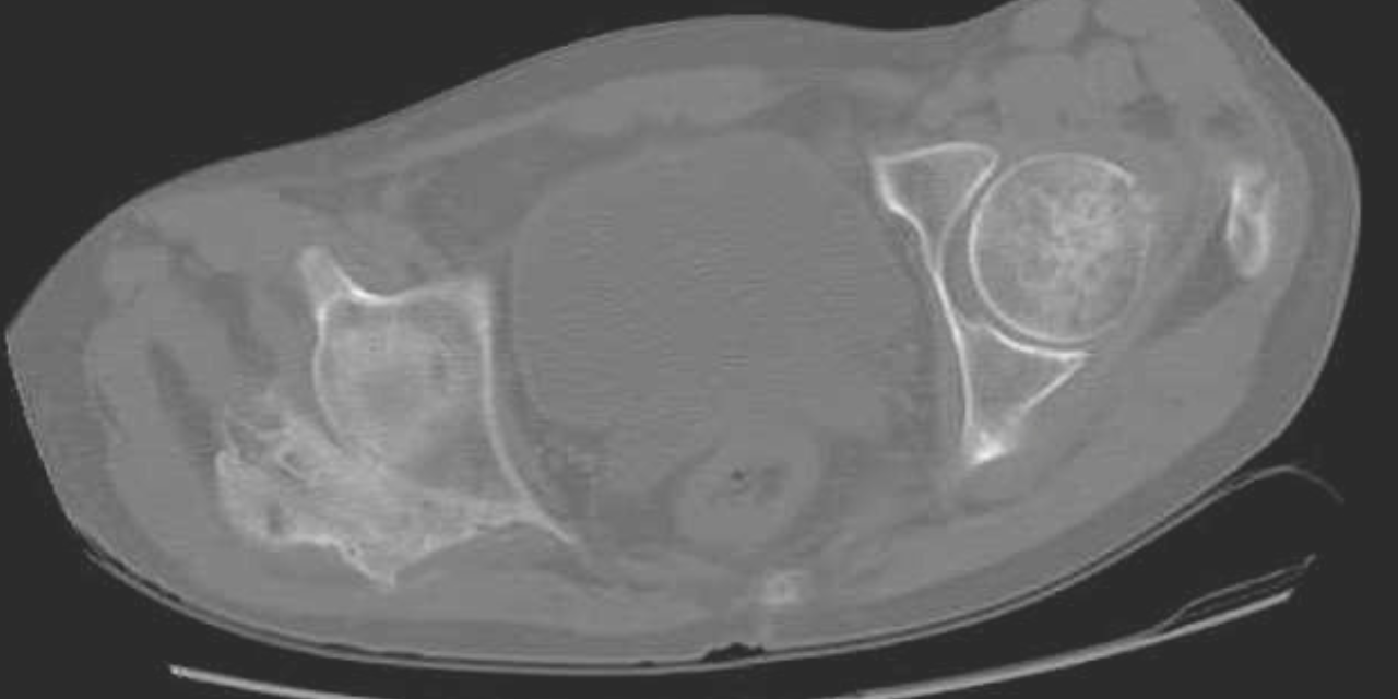 Soft Tissue Evaluation and Myositis Ossificans