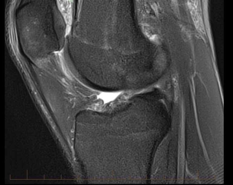 The MRI Appearance of Anterior Patellar Bursitis - Illinois ...