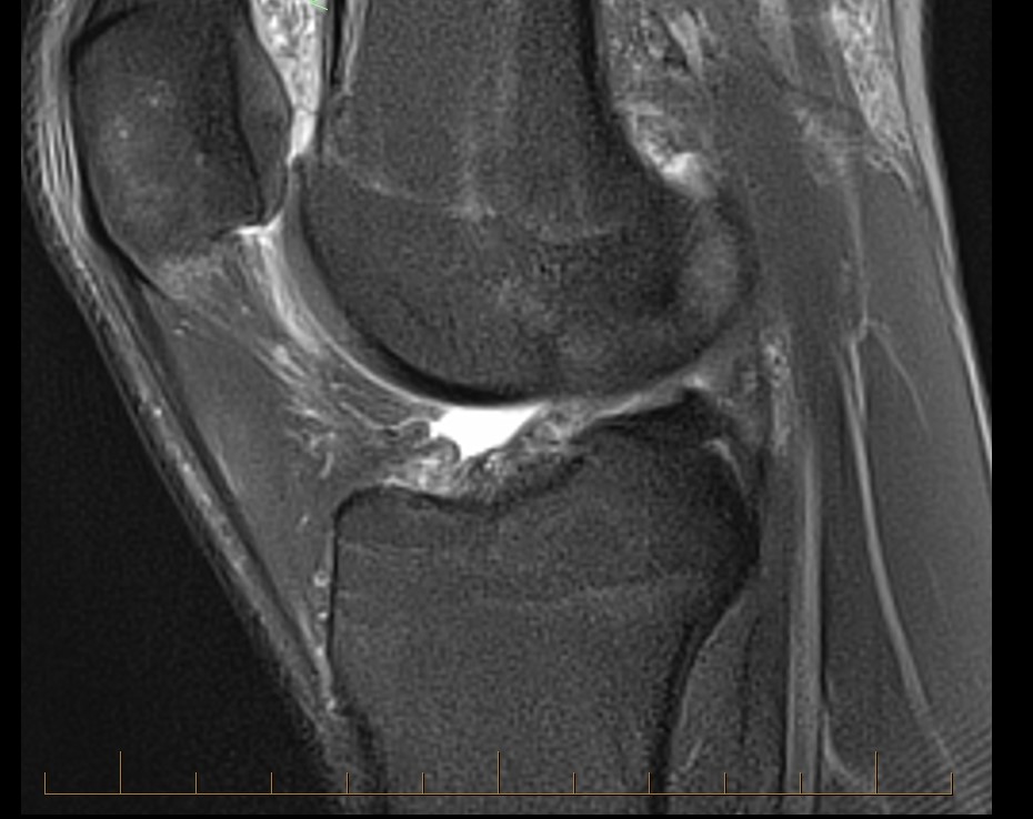 The Mri Appearance Of Anterior Patellar Bursitis - Illinois 