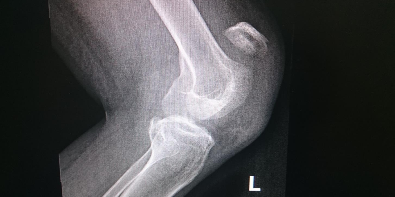 The MRI Appearance of Anterior Patellar Bursitis