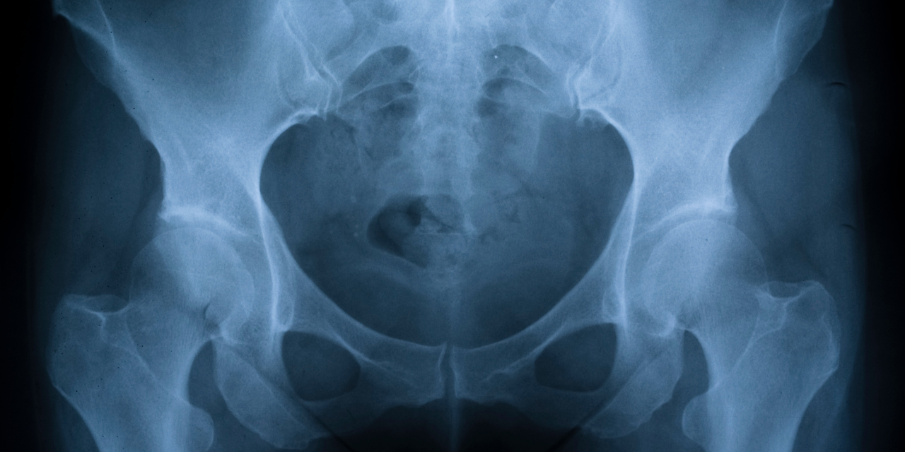 Microinstability of the Hip: An Emerging Diagnosis in the Athlete