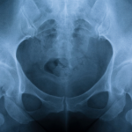 Microinstability of the Hip: An Emerging Diagnosis in the Athlete