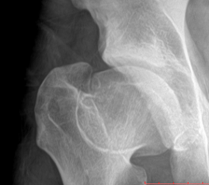 Figure 1: Zoomed in view of the left hip