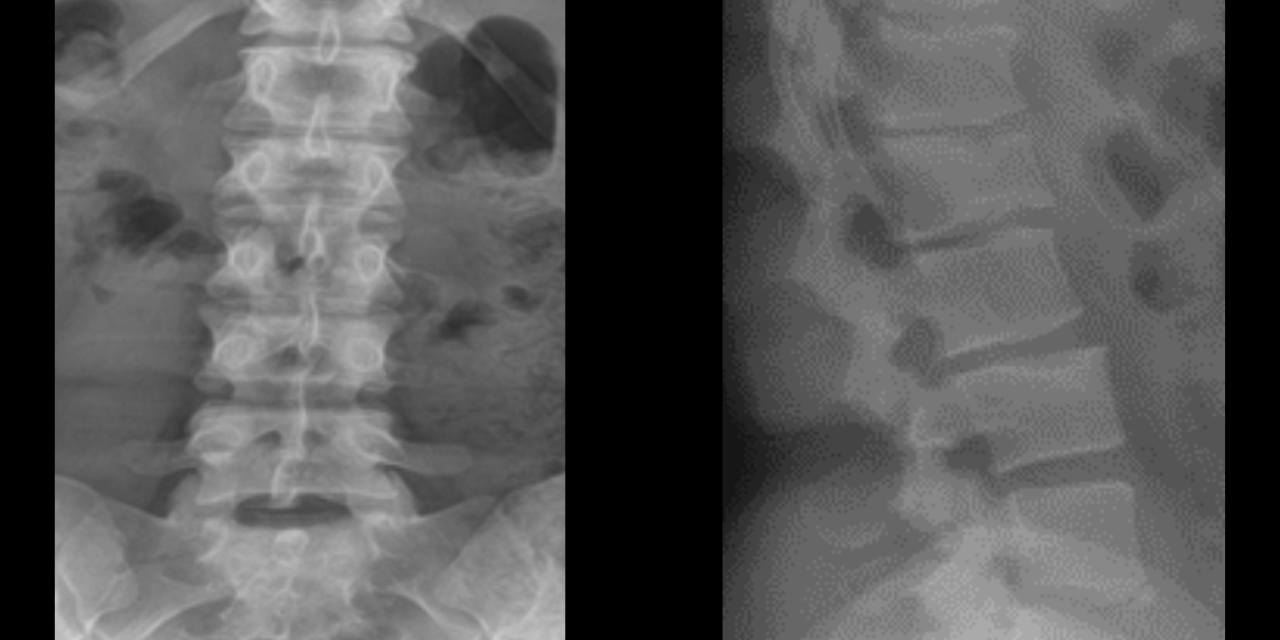 Lumbar Scheuermann’s Disease: A Rare Variation of A Commonly Understood Condition