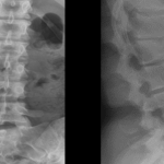 Lumbar Scheuermann’s Disease: A Rare Variation of A Commonly Understood Condition
