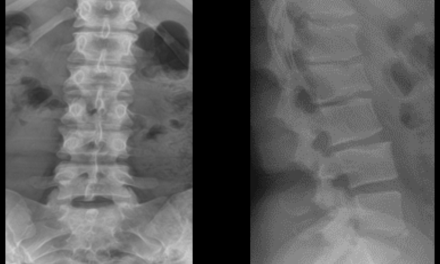 Lumbar Scheuermann’s Disease: A Rare Variation of A Commonly Understood Condition