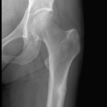 Atypical Proximal Femoral Fracture: An Important Diagnostic Consideration for Patients with Hip, Groin, or Thigh Pain