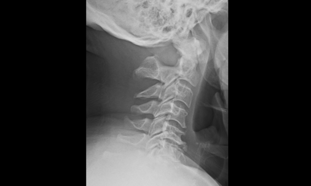Congenital Hypoplasia of the Posterior Arch of the Atlas: Radiographic Findings and Clinical Considerations