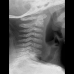 Normal Anatomic Variants of the Cervical Spine