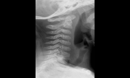 Normal Anatomic Variants of the Cervical Spine