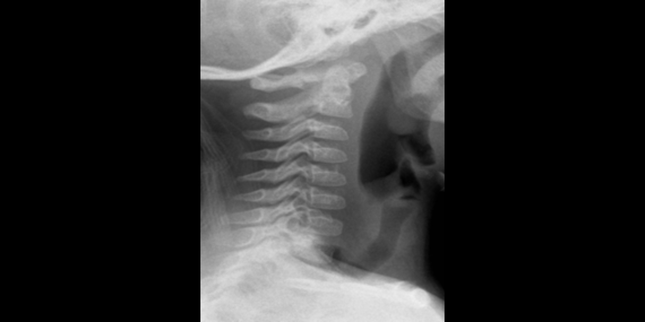 Normal Anatomic Variants of the Cervical Spine