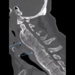 Diffuse Idiopathic Skeletal Hyperostosis (DISH): A Common Yet Complicated Condition