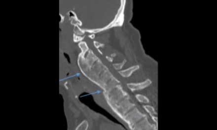 Diffuse Idiopathic Skeletal Hyperostosis (DISH): A Common Yet Complicated Condition