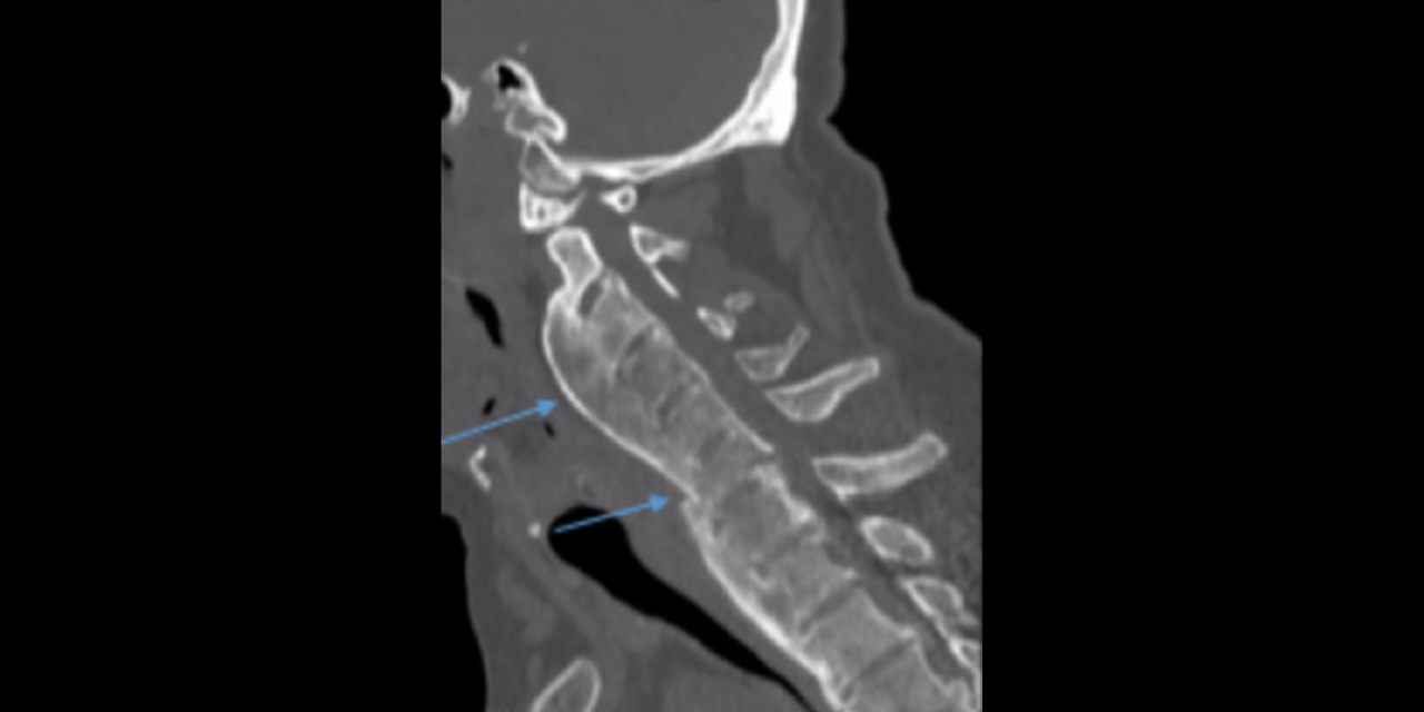 Diffuse Idiopathic Skeletal Hyperostosis (DISH): A Common Yet Complicated Condition