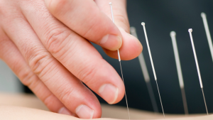 Person with acupunture needles