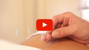 Person receiving acupuncture