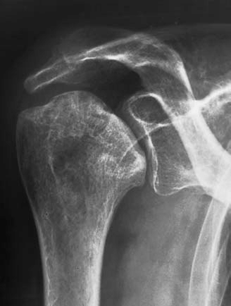 Radiology of Osteonecrosis - Illinois Chiropractic Society