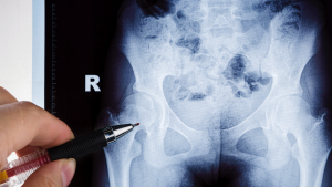 X-ray of hip