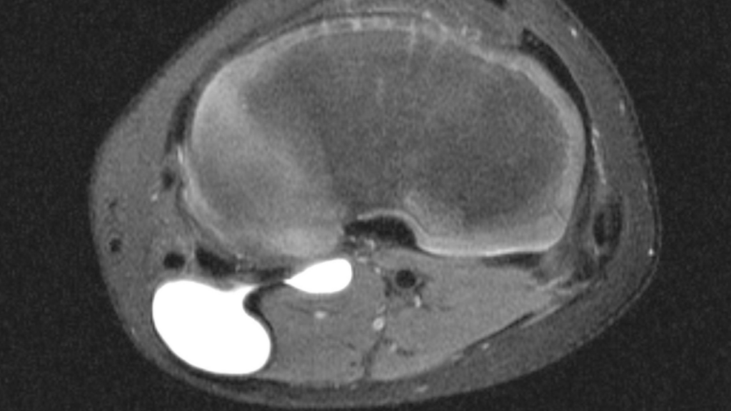 MRI of knee