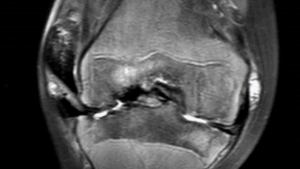 MRI of knee