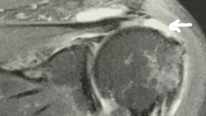 MRI of shoulder
