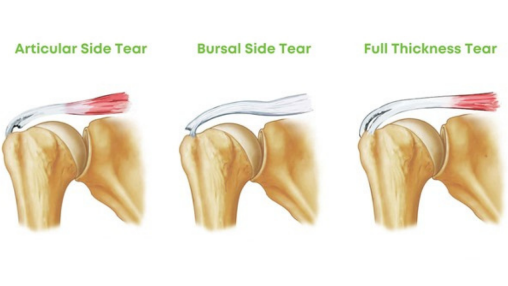Diagram of rotator cuff