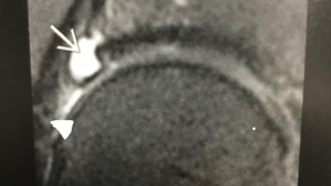MRI image of hip