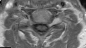 MRI of spine