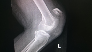 MRI image of knee