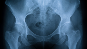 Radiographic image of pelvis and hip
