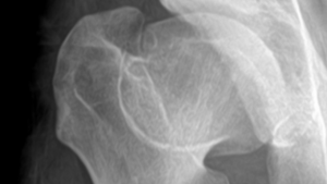 Radiographic image of left hip