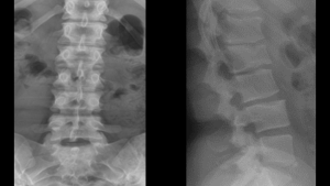 Radiographic image of spine
