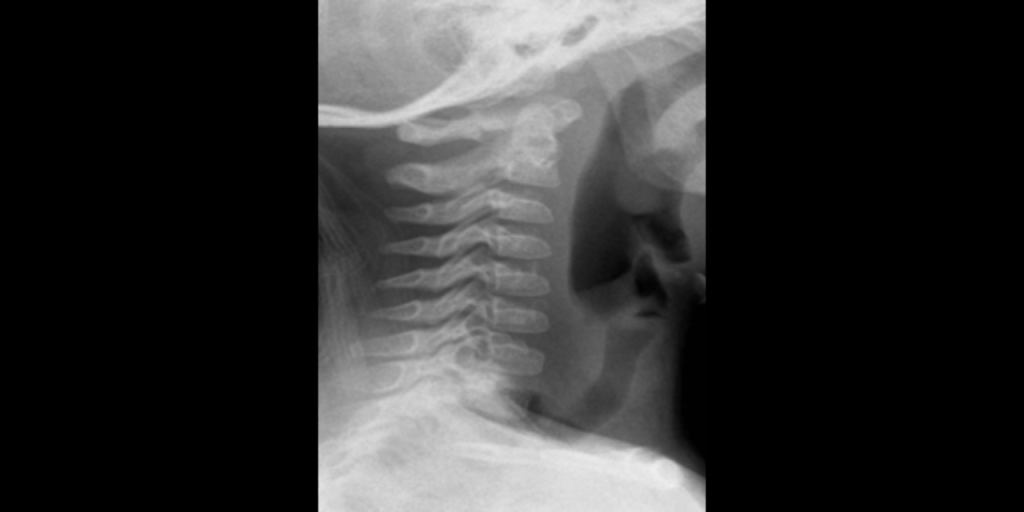 Radiographic image of cervical spine