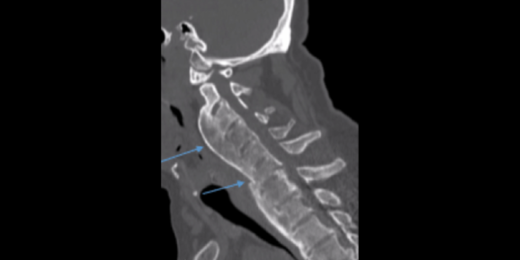 Radiographic Image of cervical spine